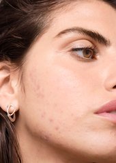 er-der-en-sammenhæng-mellem-mælkeprodukter-og-uren-hud