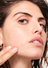 kan-fødevarer-give-akne